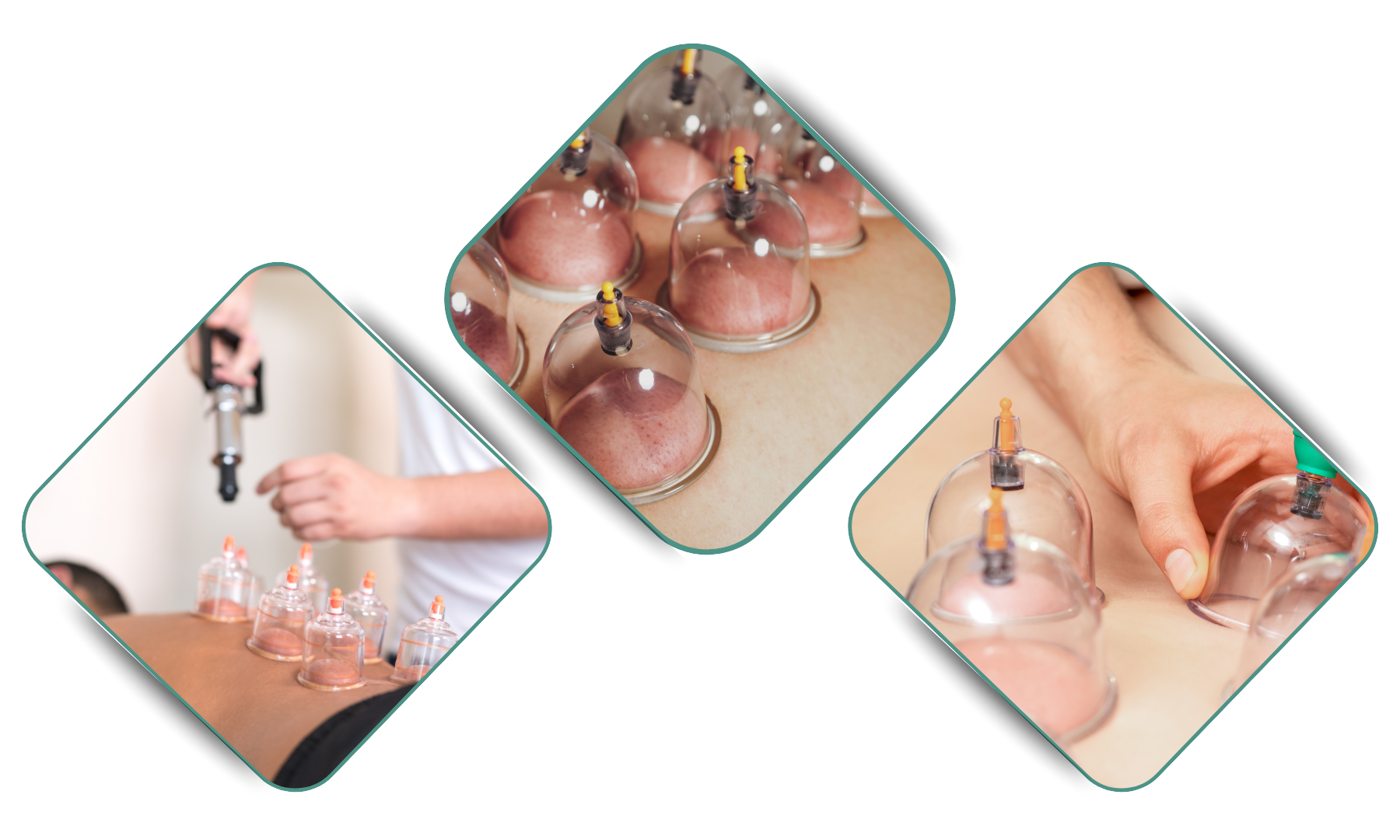 Cupping Therapy