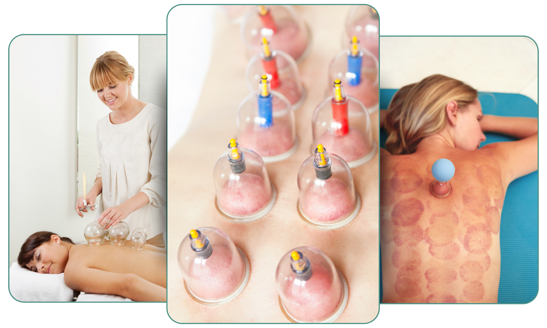 Our Cupping Therapy Approach
